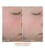 Display Product Shot: On the Spot Eliminator 2% Salicylic Acid Acne Treatment Gel, Image 4 of 5