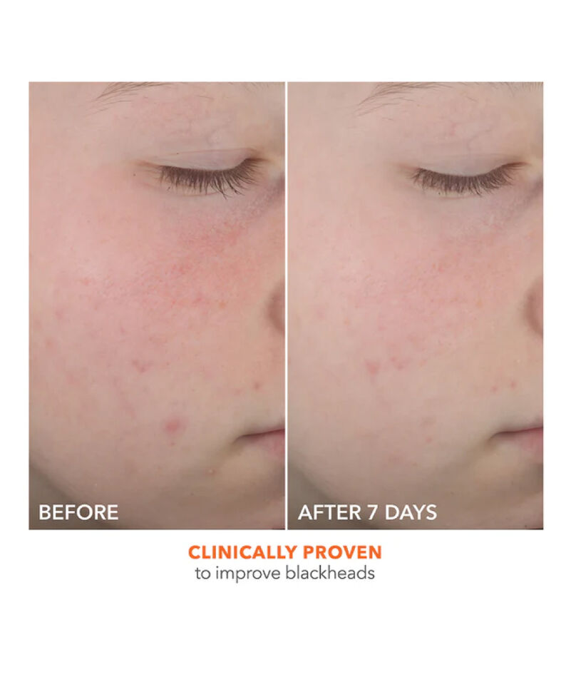 On the Spot Eliminator 2% Salicylic Acid Acne Treatment Gel, Image 4 of 5
