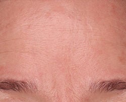 Photo after using Fill + Repair Serum with Hyaluronic Acid