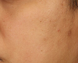 Photo after using Perfectly Dosed Treatment (Extra Strength 0.5%)