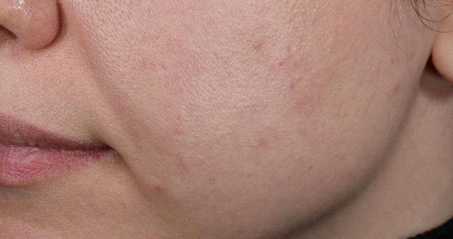 Photo before using BioRejuvenation&trade; Serum Collagen Amino Acids + G.N.A.