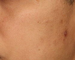Photo before using Perfectly Dosed Treatment (Extra Strength 0.5%)
