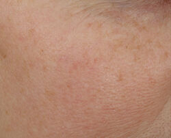 Photo after using Overnight Wrinkle Serum Treatment