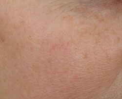 Photo after using Overnight Wrinkle Serum Treatment