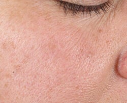 Photo before using Texture Renewal Serum