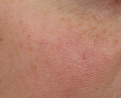 Photo before using Overnight Wrinkle Serum Treatment
