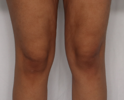 Photo before using Glow Pad Self-Tanner for Body