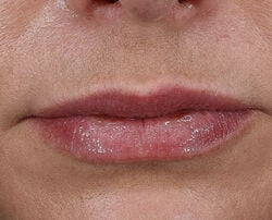 Photo after using Plump + Repair Lip Treatment with Hyaluronic Acid