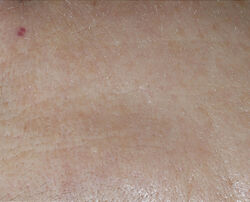 Photo after using Perfectly Dosed Treatments (Universal 0.2%)