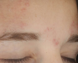 Photo after using On the Spot Eliminator 2% Salicylic Acid Acne Treatment Gel