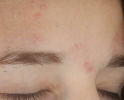 Photo after using On the Spot Eliminator 2% Salicylic Acid Acne Treatment Gel