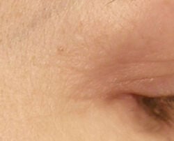 Photo after using EyeCare Max Pro LED Device