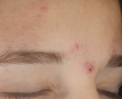 Photo before using On the Spot Eliminator 2% Salicylic Acid Acne Treatment Gel