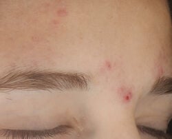 Photo before using On the Spot Eliminator 2% Salicylic Acid Acne Treatment Gel