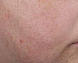 Photo after using Blur + Repair Moisturizer Cream with Hyaluronic Acid