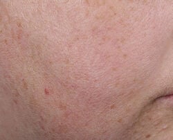 Photo after using Blur + Repair Moisturizer Cream with Hyaluronic Acid