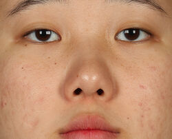 Photo after using 2% BHA+ Breakout Solution