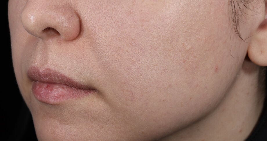Photo after using BioRejuvenation&trade; Serum Collagen Amino Acids + G.N.A.