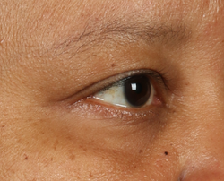 Photo after using Fill + Repair Serum with Hyaluronic Acid