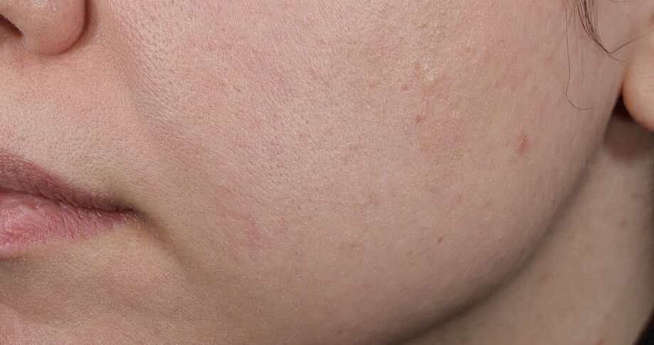 Photo after using BioRejuvenation&trade; Serum Collagen Amino Acids + G.N.A.