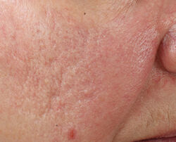 Photo before using Ultra Gentle Daily Peel