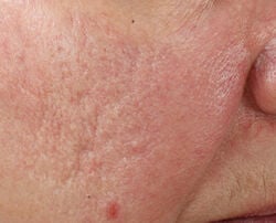 Photo before using Ultra Gentle Daily Peel