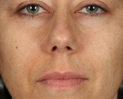 Photo before using Glow Pad Self-Tanner for Face