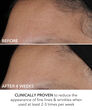 Display Product Shot: Perfectly Dosed Treatment (Extra Strength 0.5%), Image 7 of 11