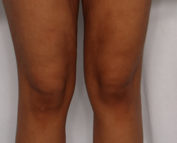 Photo after using Glow Pad Self-Tanner for Body