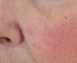 Photo before using Dewy Deep Cream