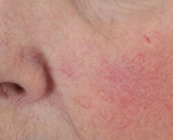 Photo before using Dewy Deep Cream