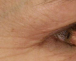 Photo before using EyeCare Max Pro LED Device