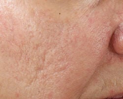 Photo after using Ultra Gentle Daily Peel