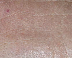 Photo before using Perfectly Dosed Treatments (Universal 0.2%)