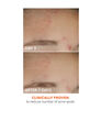 Display Product Shot: On the Spot Eliminator 2% Salicylic Acid Acne Treatment Gel, Image 3 of 5