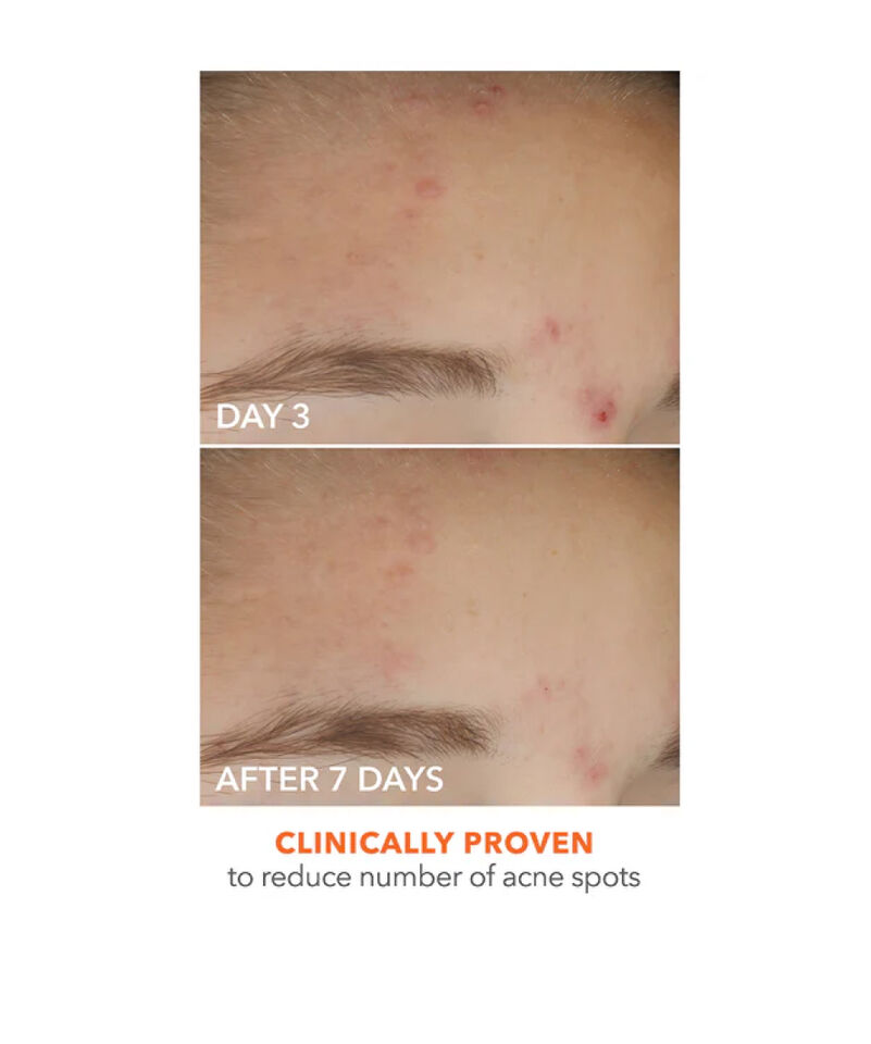 On the Spot Eliminator 2% Salicylic Acid Acne Treatment Gel, Image 3 of 5