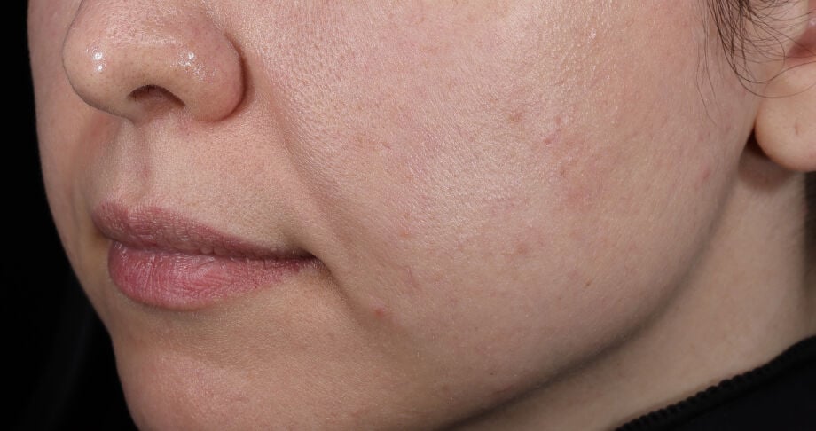 Photo before using BioRejuvenation&trade; Serum Collagen Amino Acids + G.N.A.