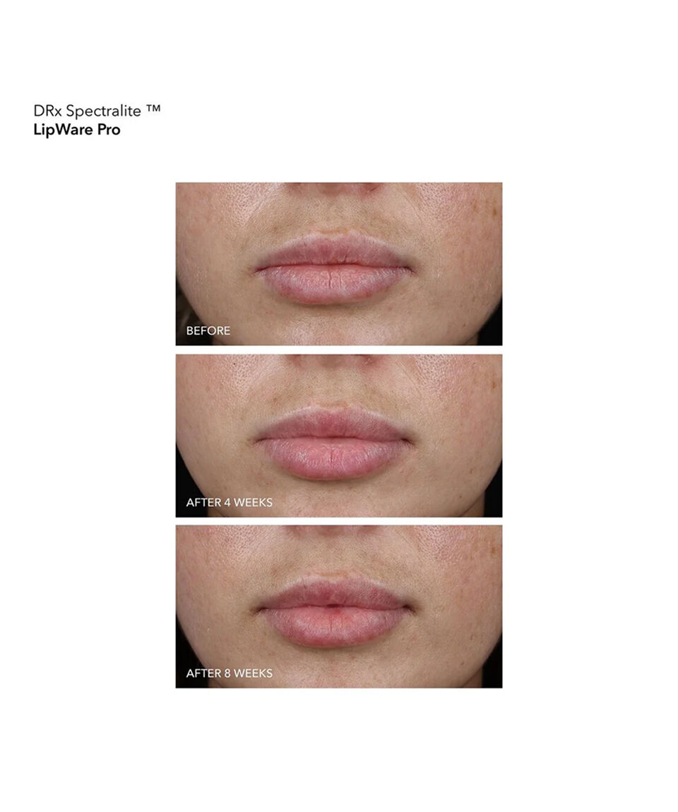 DRx SpectraLite™ LipWare Pro Lip Mask | Dr. Dennis Gross