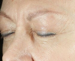 Photo before using Triple Correction Eye Serum
