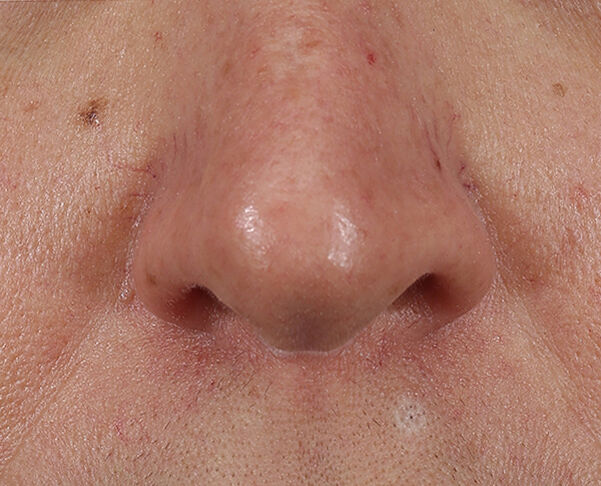 Photo after using Lift + Repair Eye Mask