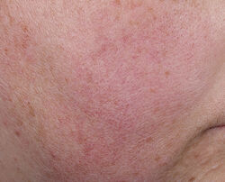 Photo before using Blur + Repair Moisturizer Cream with Hyaluronic Acid
