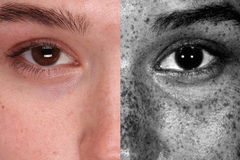 Why Your Skin Needs a Wood’s Lamp Exam
