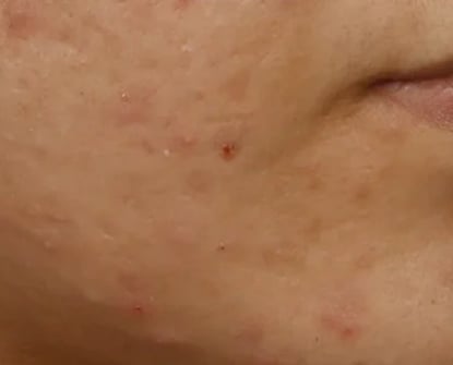 After Acne Treatment