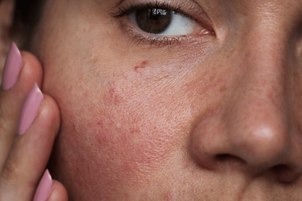 How to Get Rid of Redness on Your Face