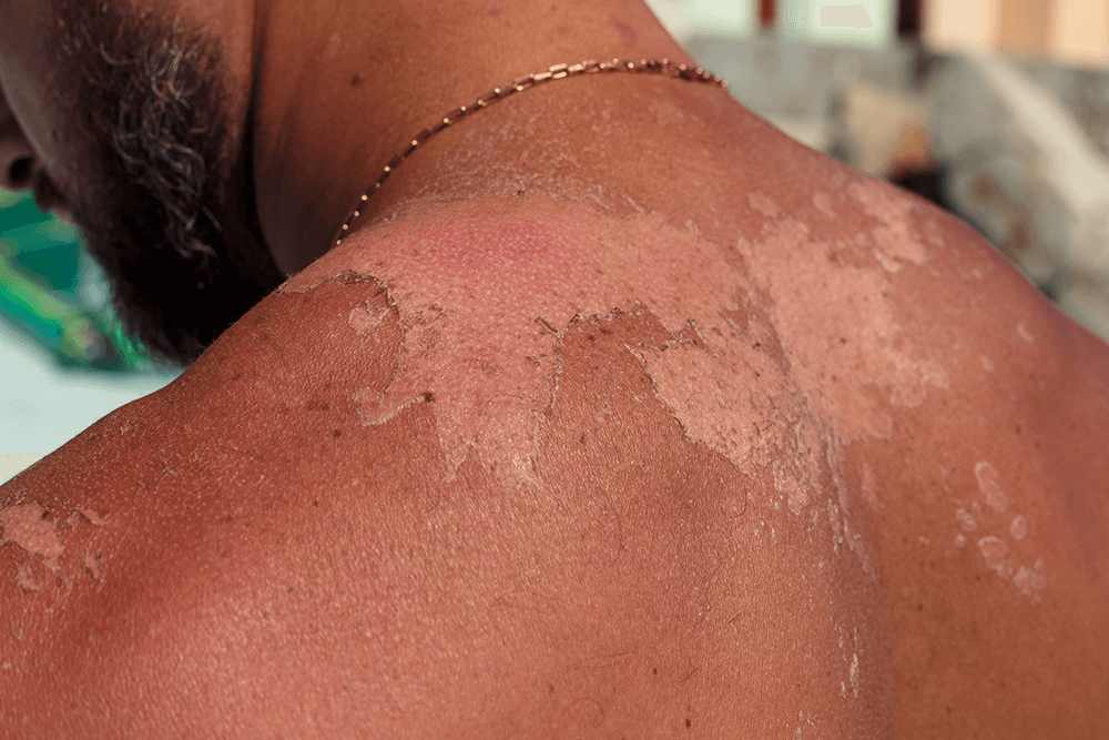 How To Treat Sunburn: 6 Tips For A Really Bad Sunburn