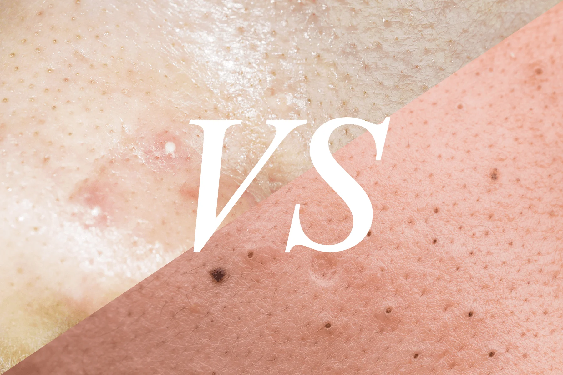 Whiteheads vs Blackheads: Causes, Differences, and Tips for Prevention