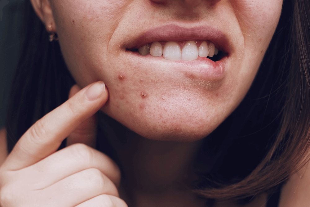 How to Help Hormonal Acne and Breakouts