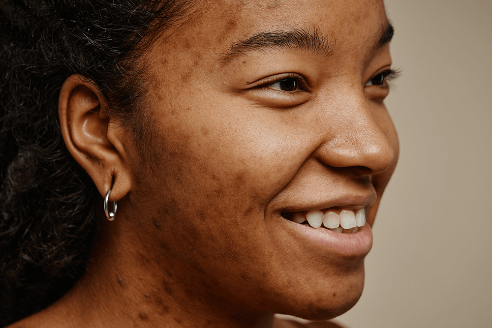 The Ultimate Guide to Tranexamic Acid for Skin