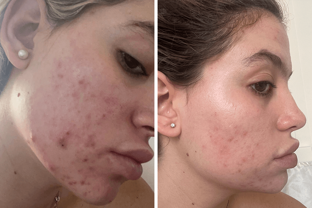 Skincare Success Story: Cystic Acne to Clear Skin