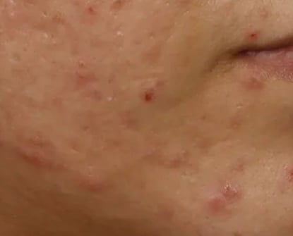 Before Acne Treatment